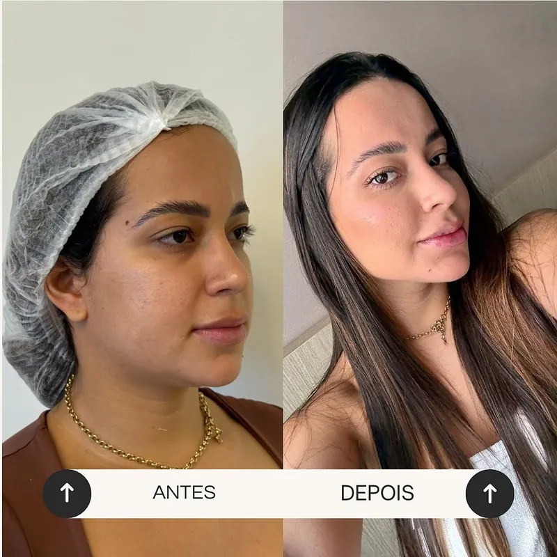 Antes e depois de full face