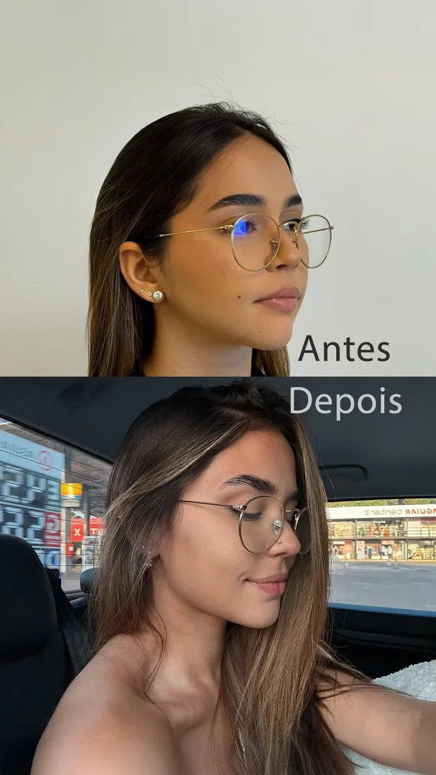 Antes e depois de perfiloplastia