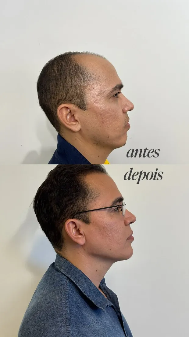 Antes e depois de harmonização masculina de perfil